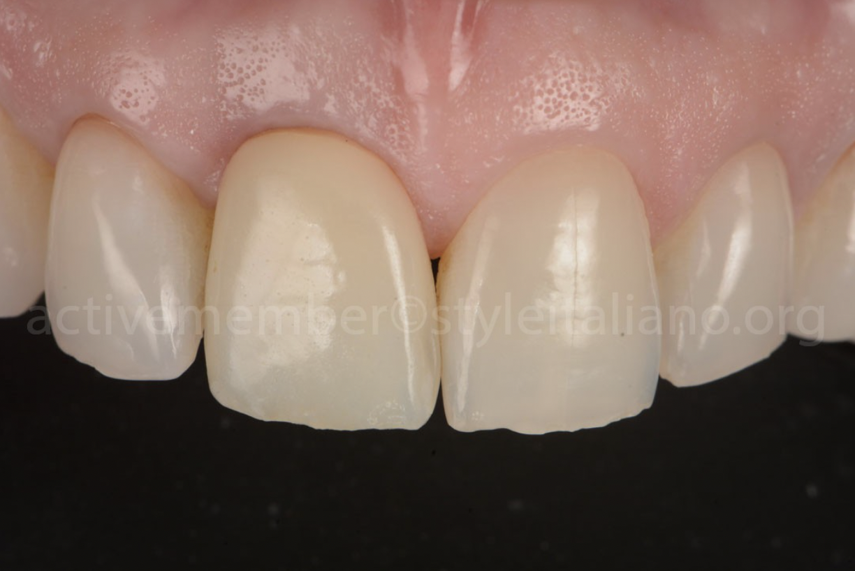 Phục hình thẩm mỹ răng cửa bằng sự kết hợp giữa Veneer và implant